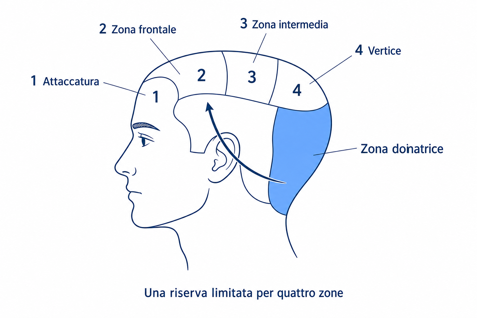 Schema: la zona donatrice limitata sulla nuca rifornisce quattro zone riceventi numerate, dall'attaccatura al vertice