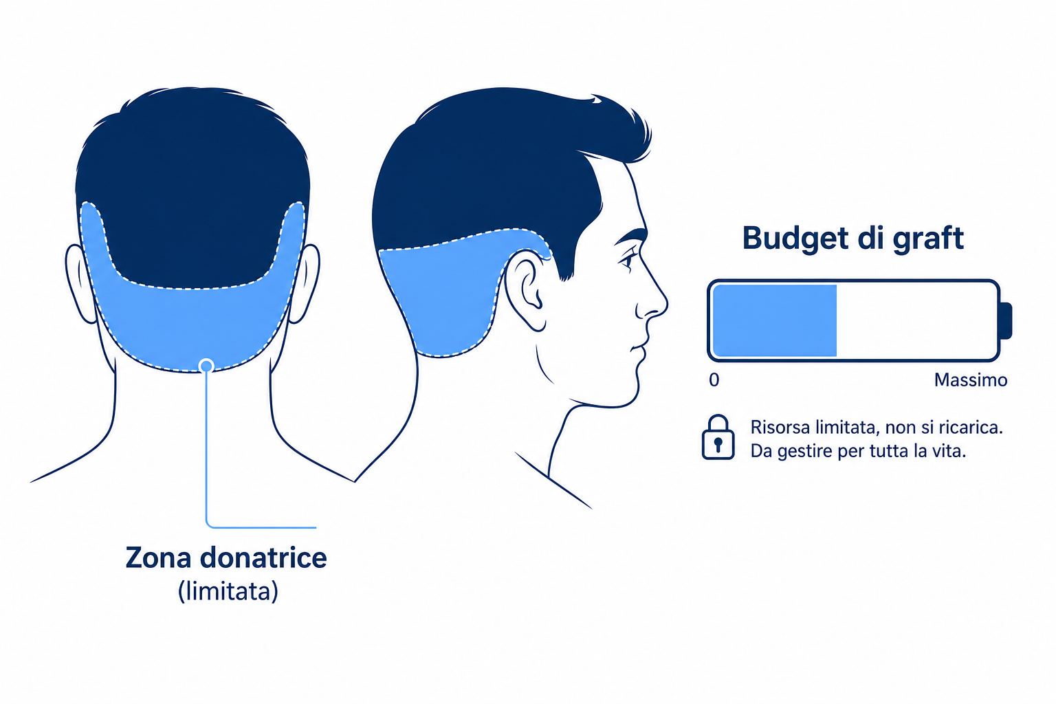 Diagramma della zona donatrice limitata sulla nuca come budget di graft per tutta la vita
