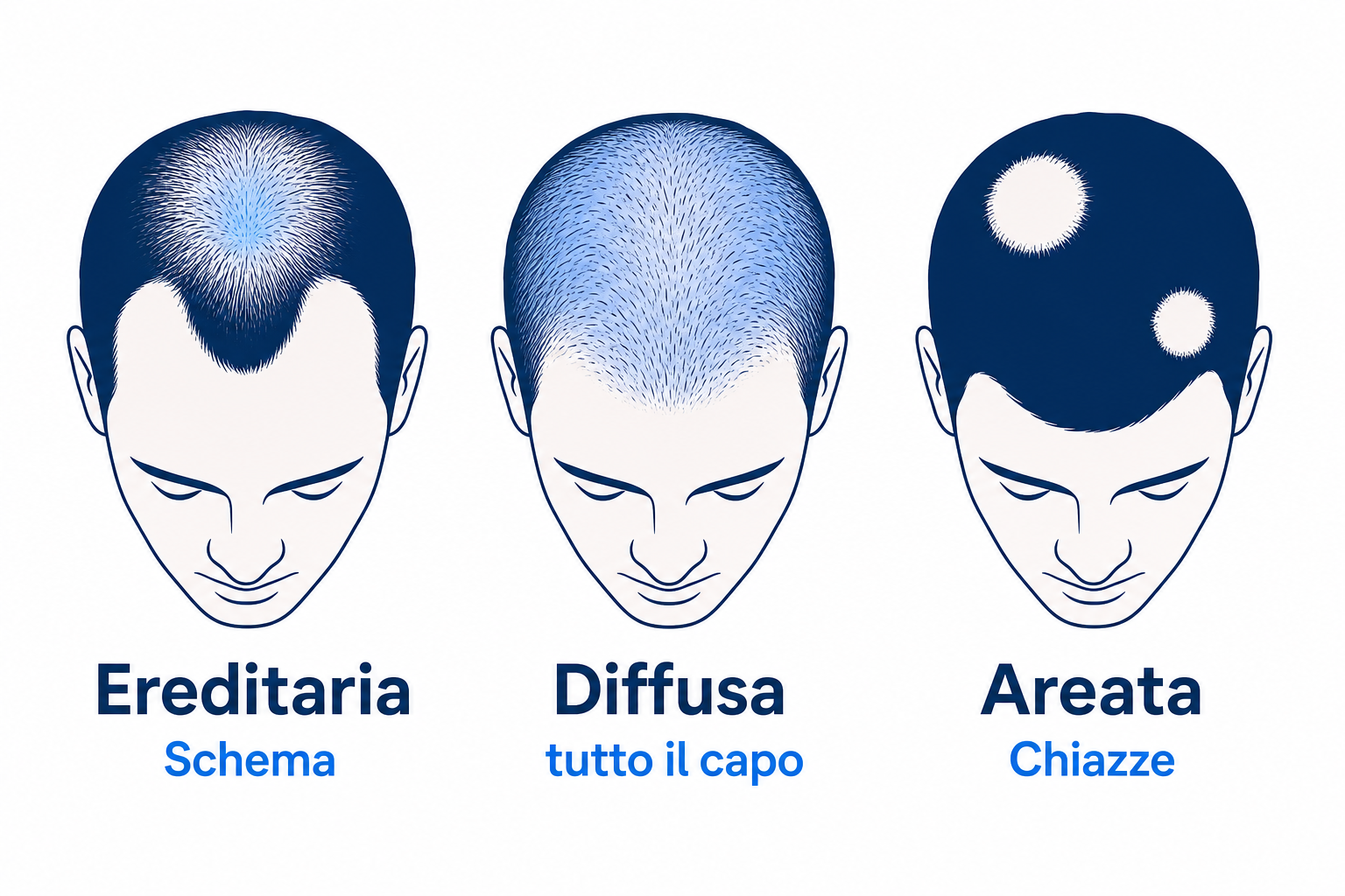 Infografica dei tre tipi di caduta dei capelli: ereditaria, diffusa e areata