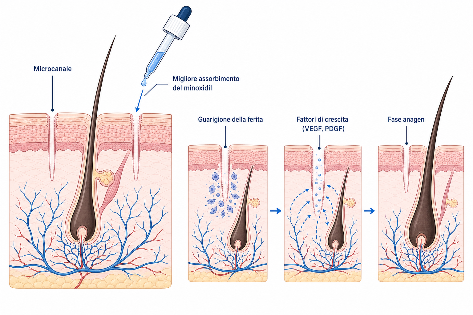Illustrazione del meccanismo d'azione del microneedling sulla cute: microcanale, guarigione della ferita, fattori di crescita e fase anagen