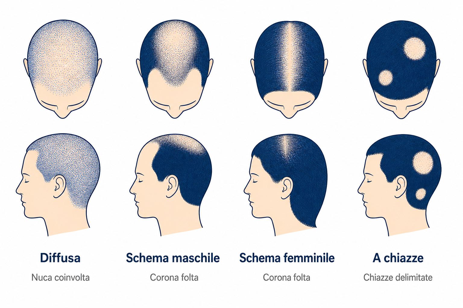 Infografica: caduta dei capelli diffusa, schema maschile e femminile e alopecia areata a confronto