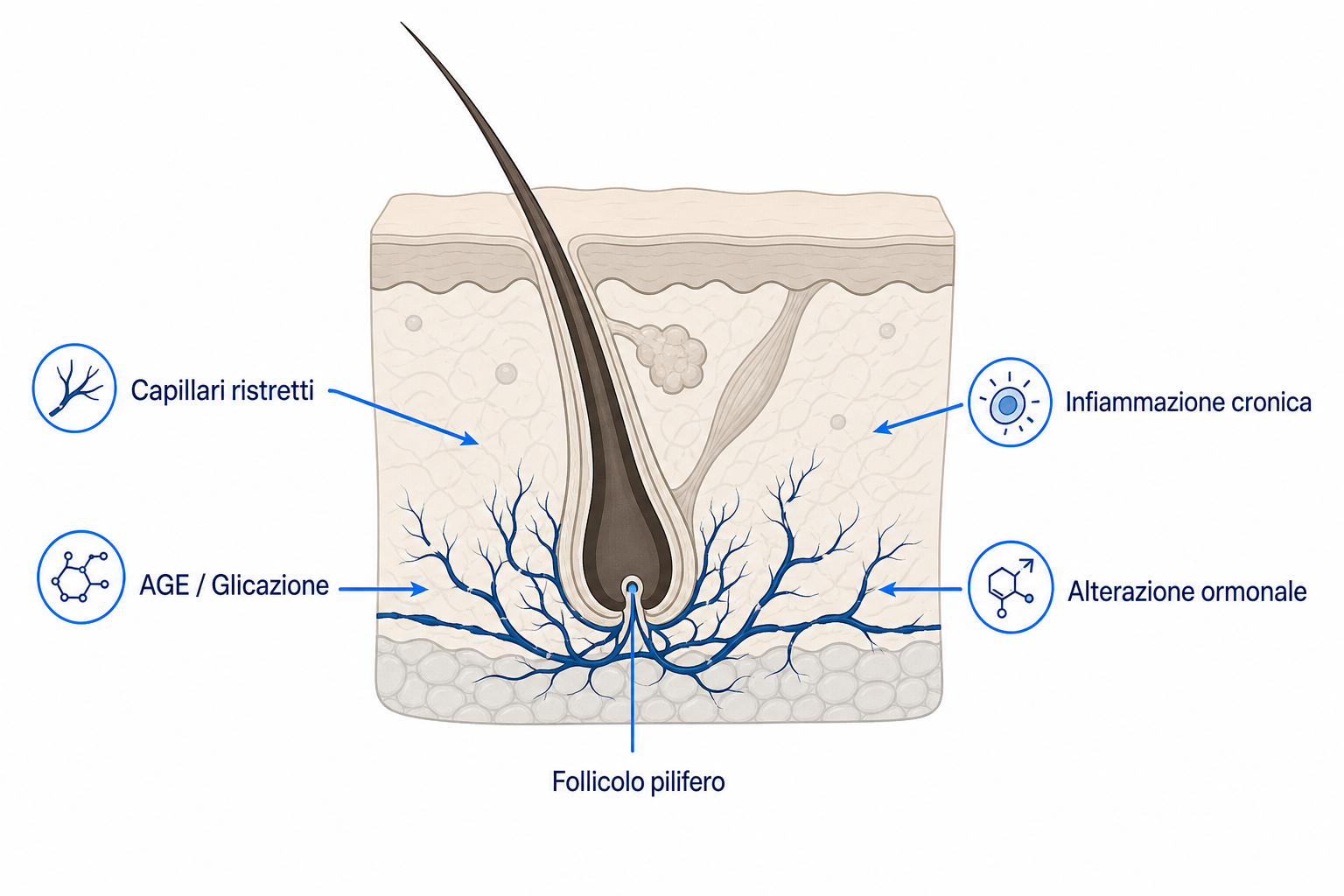 Illustrazione di un follicolo pilifero in sezione cutanea con i quattro meccanismi con cui il diabete disturba la crescita dei capelli