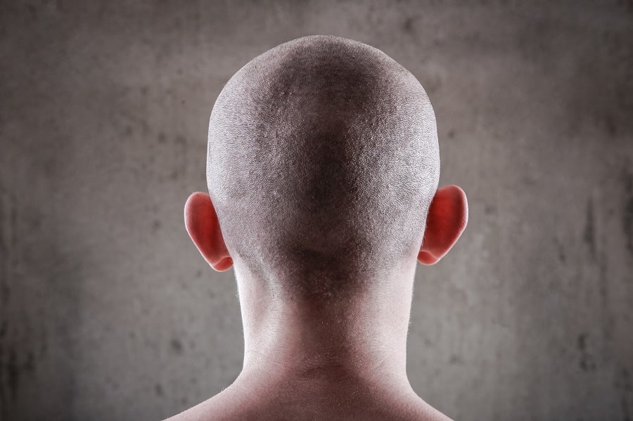queda de cabelo