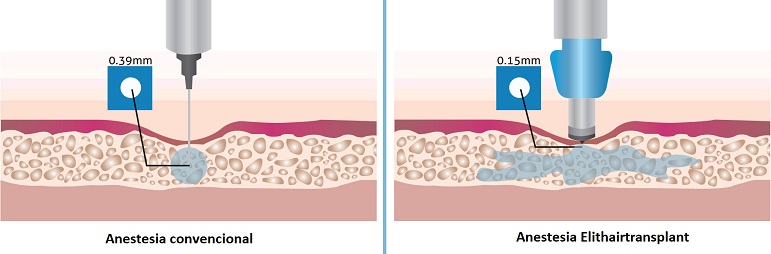 infográfico: Anestesia convencional vs. anestesia Elithair 