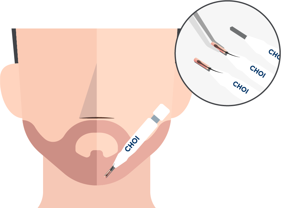 Ilustração da inserção de enxertos com a técnica DHI para um transplante de barba
