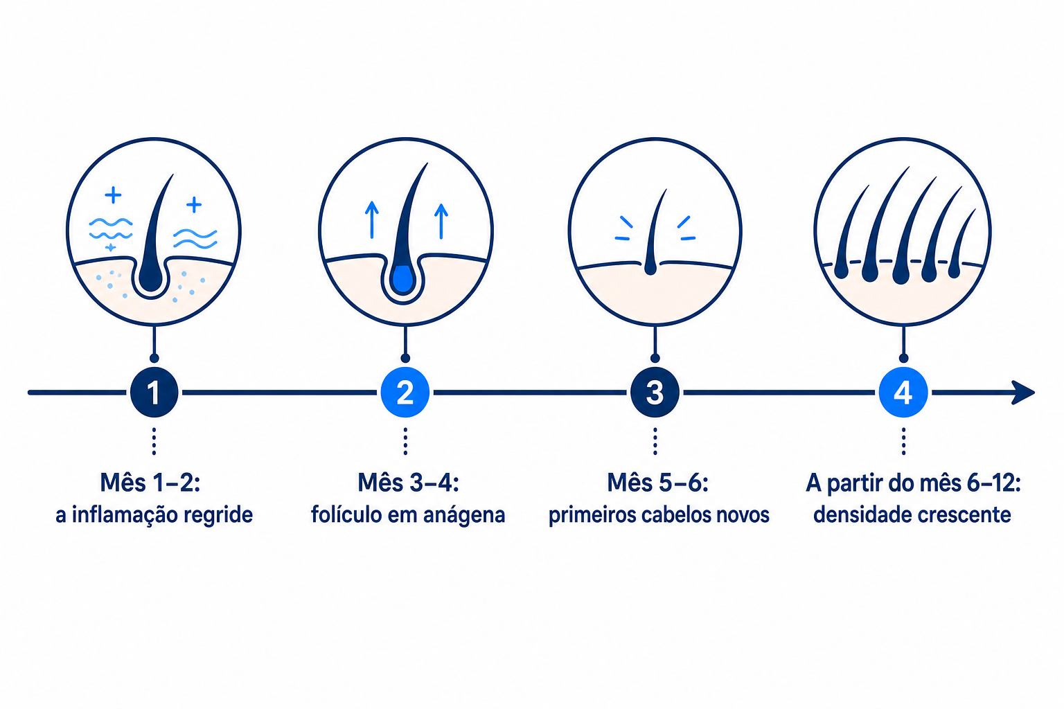Cronologia: novo crescimento do cabelo após uma terapêutica de cortisona bem-sucedida ao longo de doze meses