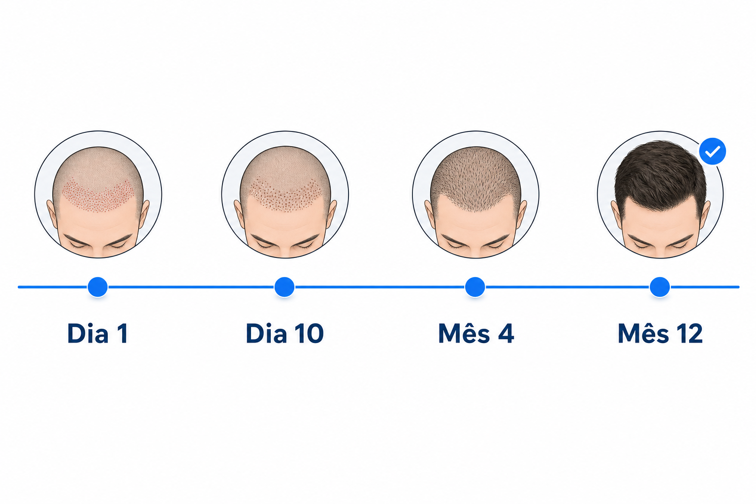 Evolução da cicatrização após um transplante capilar sem rapar, do dia 1 ao mês 12
