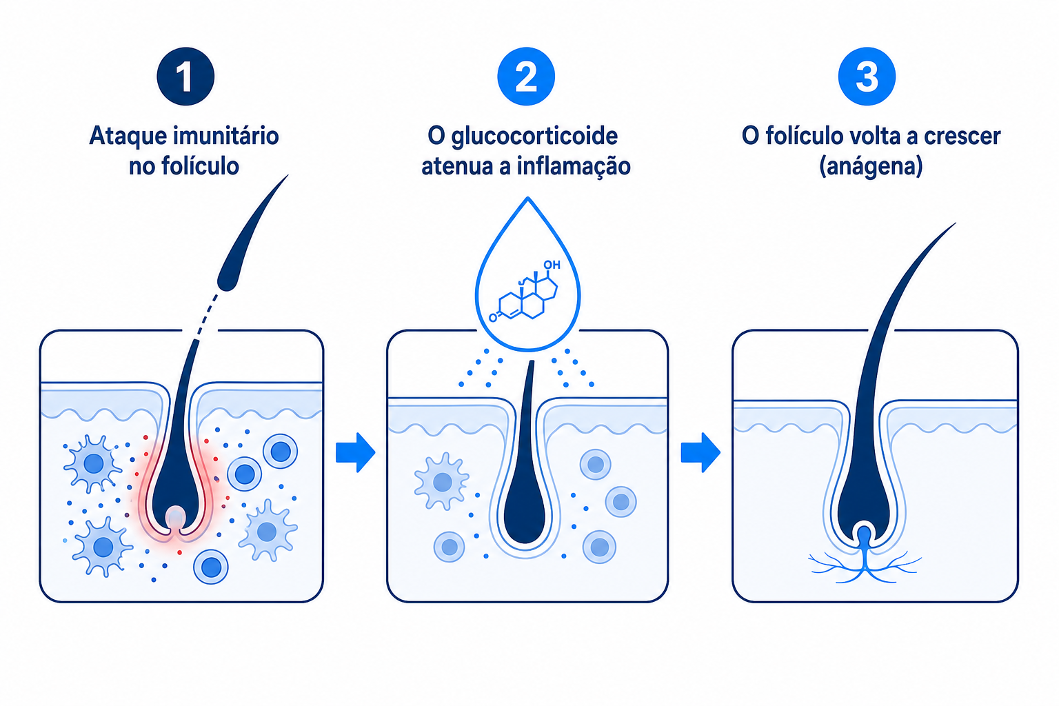 Infografia: como os glucocorticoides atenuam o ataque imunitário no folículo capilar e permitem o novo crescimento