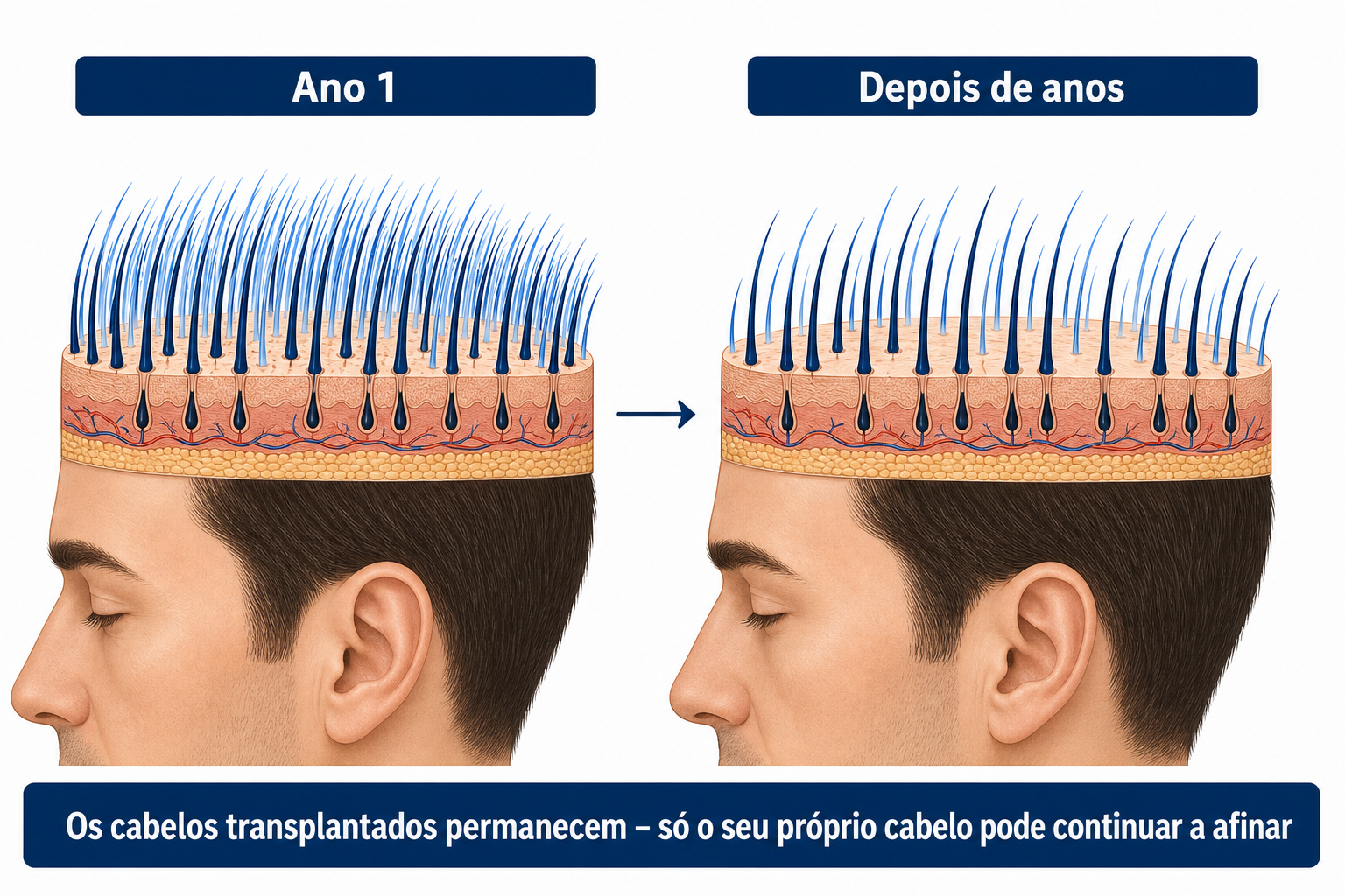 Os cabelos transplantados mantêm-se permanentemente; só o próprio cabelo entre eles pode continuar a rarear ao longo dos anos