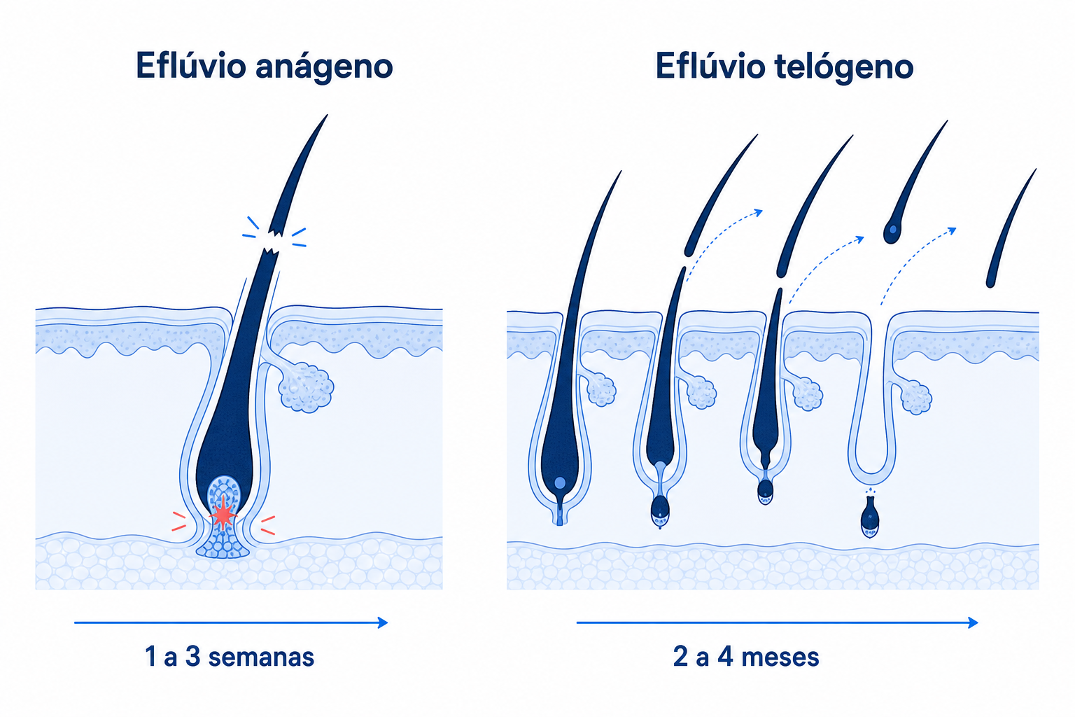 Comparação entre eflúvio anágeno e telógeno: quebra do cabelo na fase de crescimento após 1 a 3 semanas versus queda difusa na fase de repouso após 2 a 4 meses