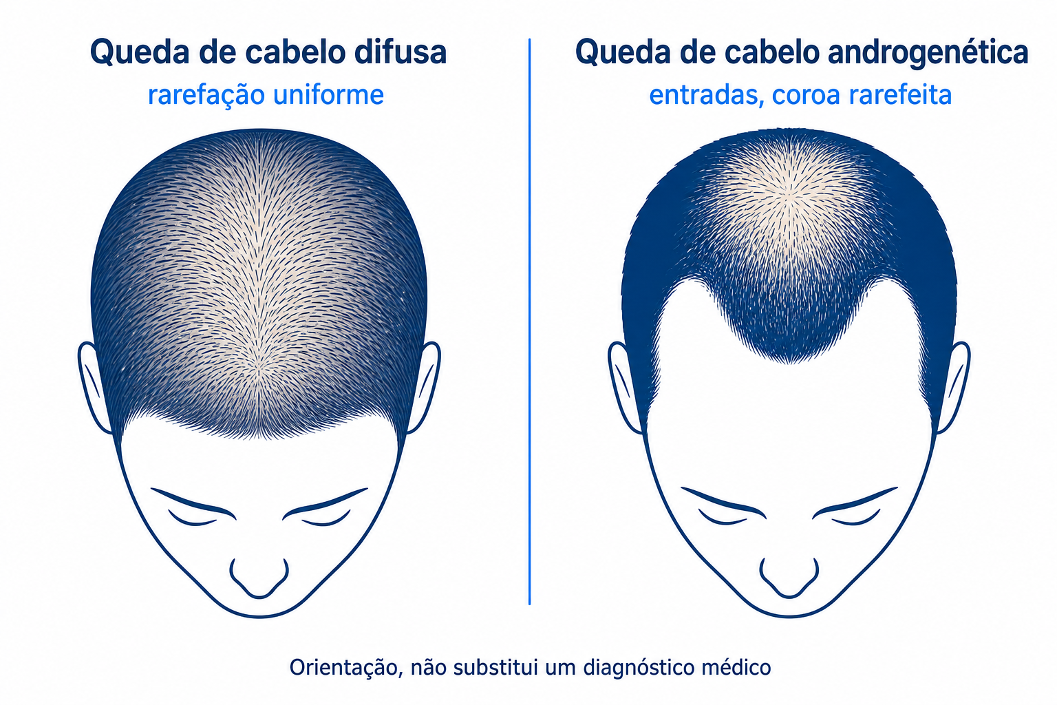 Diagrama comparativo entre queda de cabelo difusa e androgenética, duas silhuetas de cabeça com padrão de rarefação