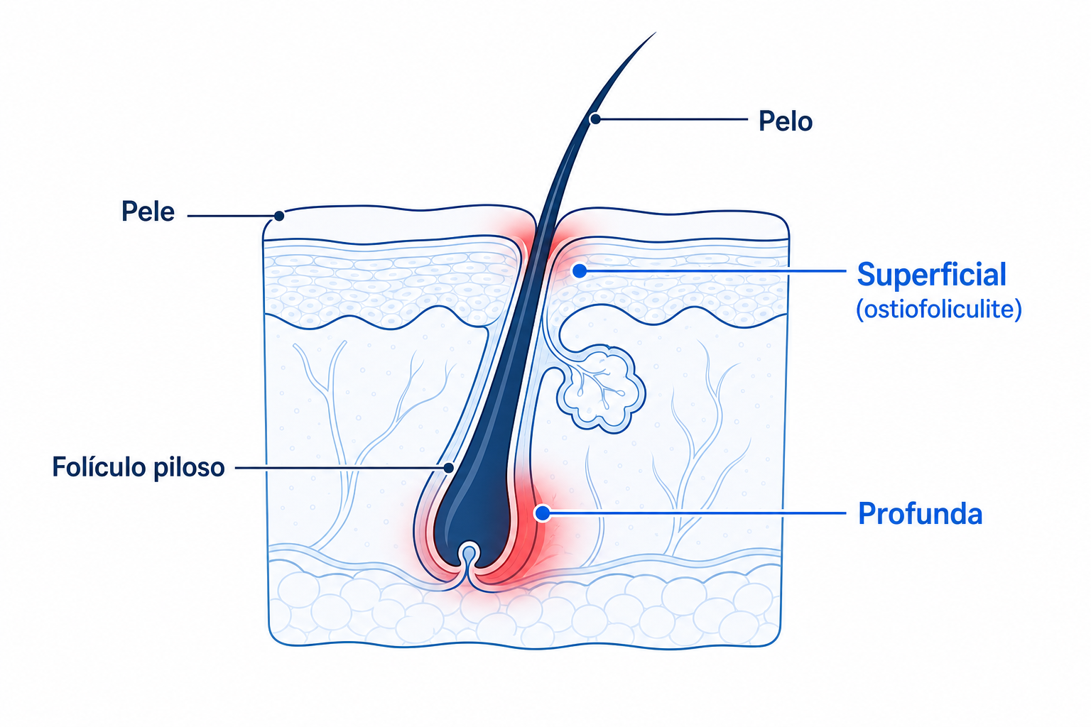 Corte transversal de um folículo piloso com zona de inflamação superficial e profunda