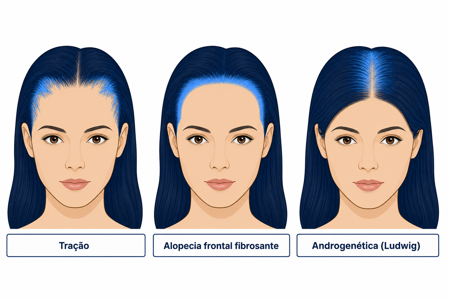Três diagramas de cabeça feminina em comparação: tração, alopecia frontal fibrosante e padrão androgenético de Ludwig
