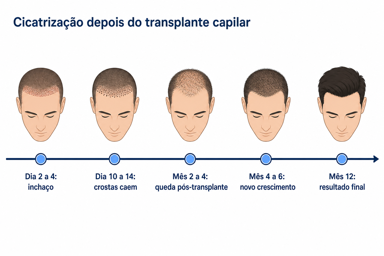 Linha temporal da cicatrização depois do transplante capilar, do dia 2 ao mês 12