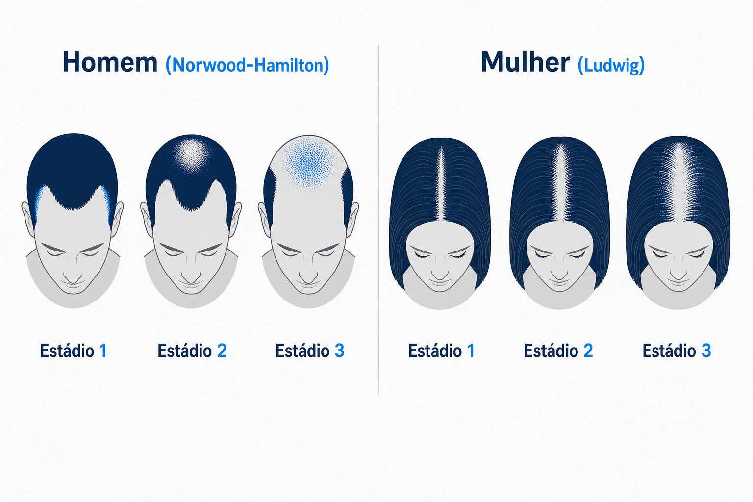 Comparação esquemática dos padrões de queda de cabelo no homem (Norwood-Hamilton) e na mulher (Ludwig) na alopecia androgenética