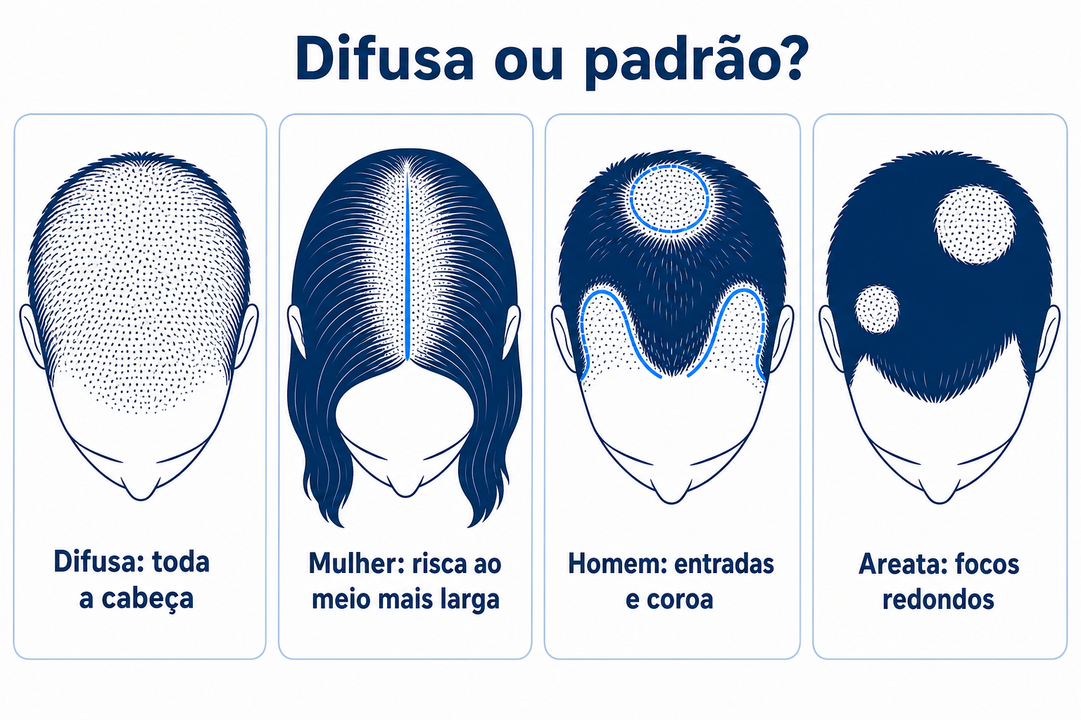 Comparação de quatro padrões de queda de cabelo: rarefação difusa em toda a cabeça, risca ao meio mais larga na mulher, entradas e coroa no homem, focos redondos sem cabelo na alopecia areata