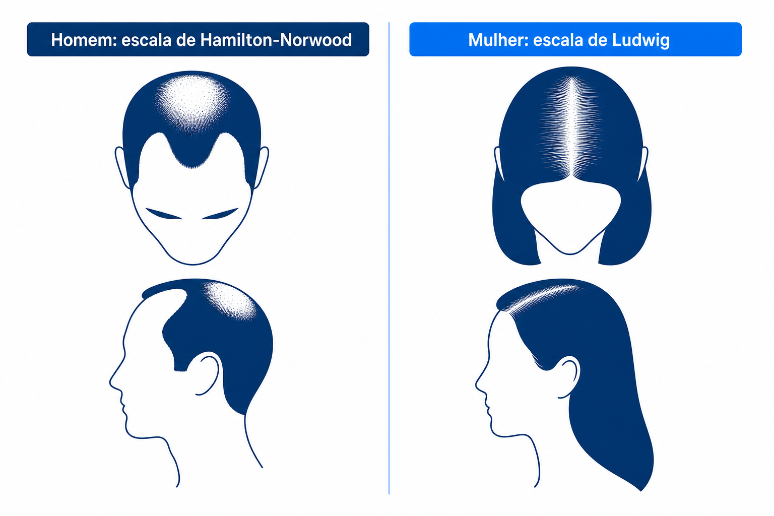 Comparação dos padrões de queda de cabelo androgenética no homem (escala de Hamilton-Norwood) e na mulher (escala de Ludwig), lado a lado