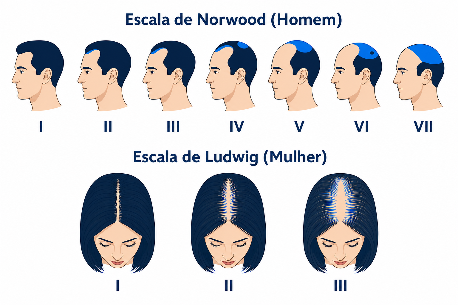 Escala de Norwood para homens e escala de Ludwig para mulheres para classificar a queda de cabelo em padrão