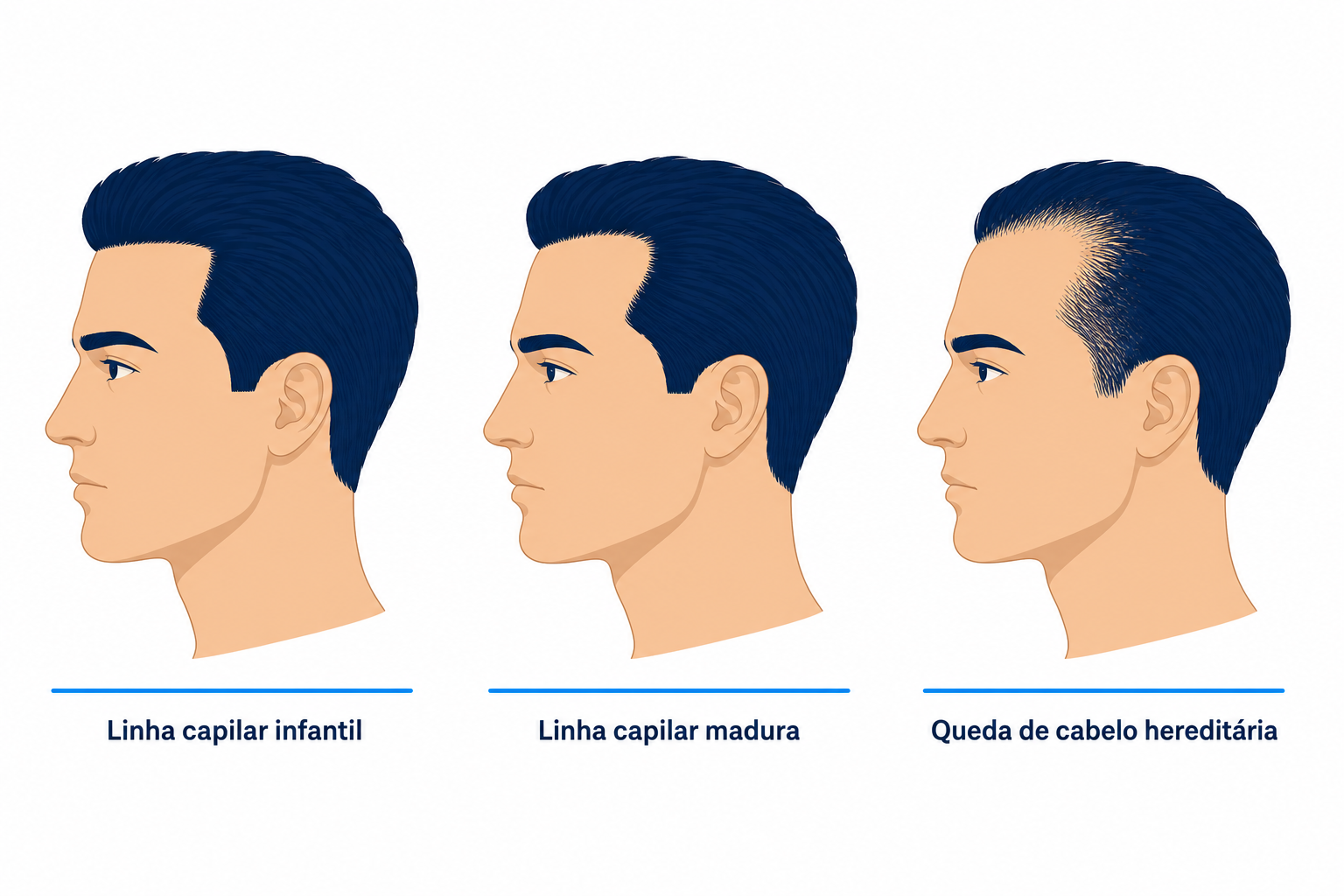 Três perfis de cabeça em comparação: linha capilar infantil, linha capilar madura e queda de cabelo hereditária