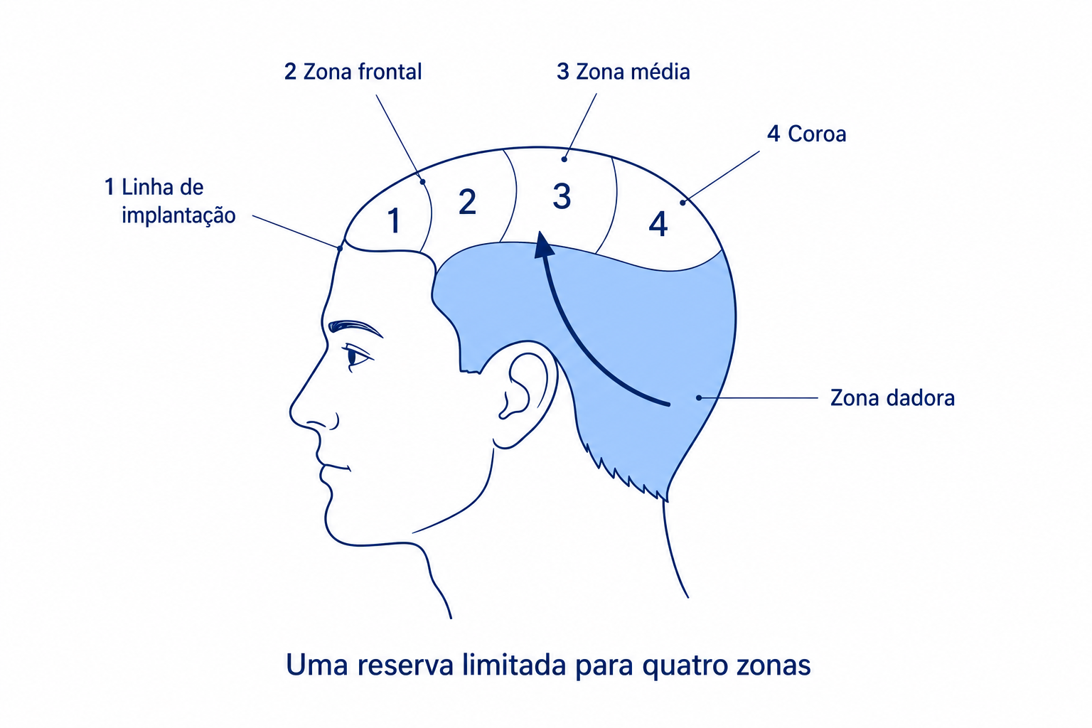Diagrama: a zona dadora limitada na parte de trás da cabeça abastece quatro zonas recetoras numeradas, da linha de implantação até à coroa