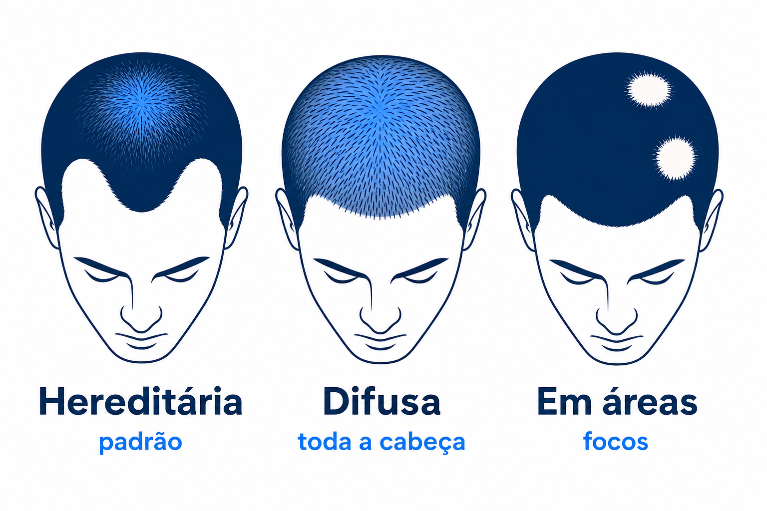 Infografia dos três tipos de queda de cabelo: hereditária, difusa e em áreas
