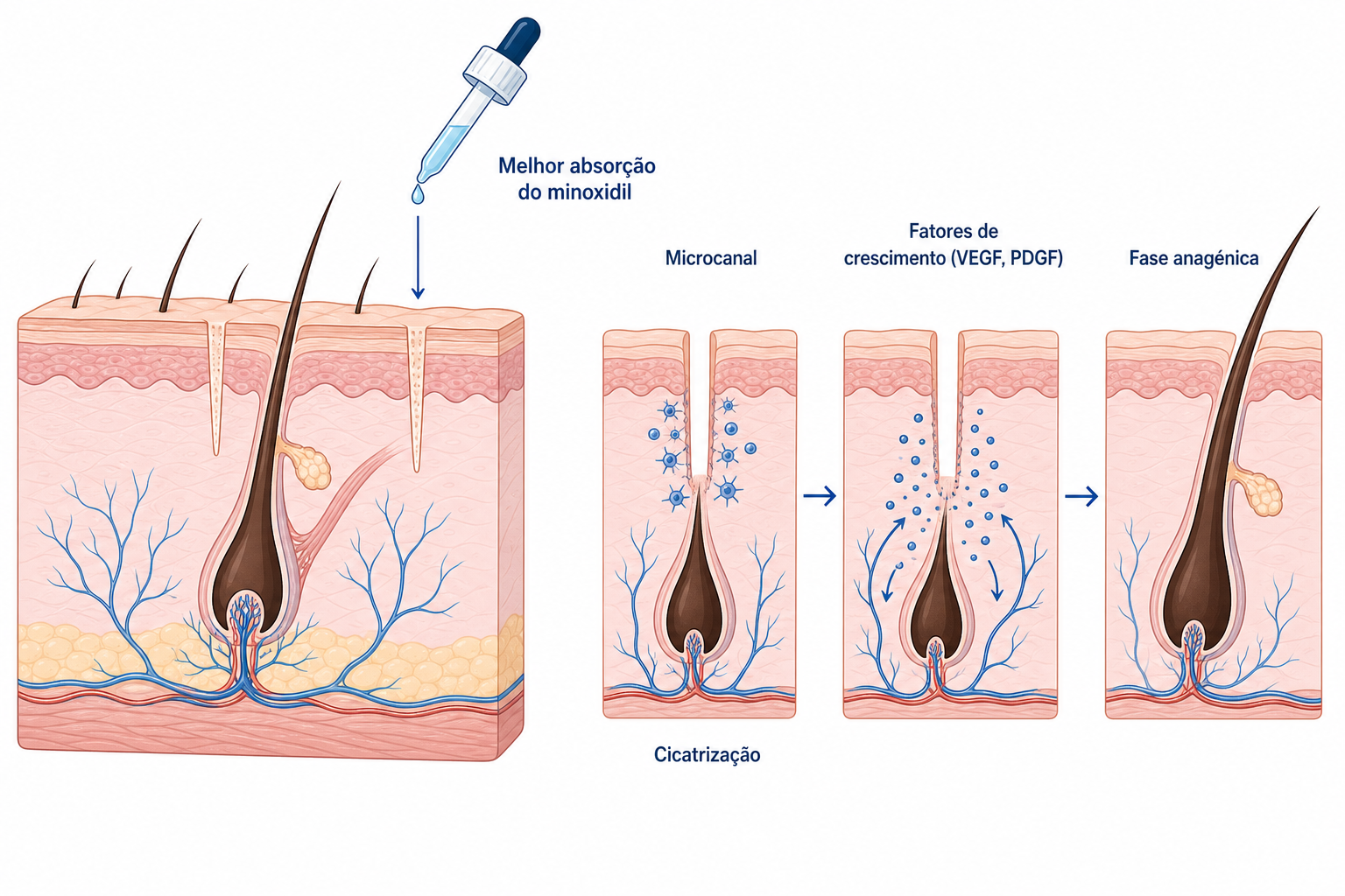 Ilustração do mecanismo de ação do microneedling no couro cabeludo: microcanal, cicatrização, fatores de crescimento e fase anagénica