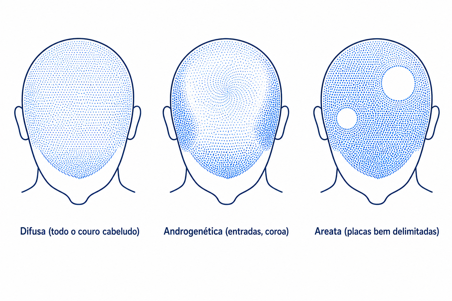 Comparação dos três padrões de queda: difusa, androgenética e areata, em silhuetas de cabeça