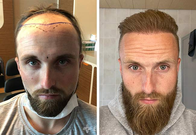 Antes e depois de um transplante capilar Sapphire com 4.700 enxertos do paciente Frederic Gigers