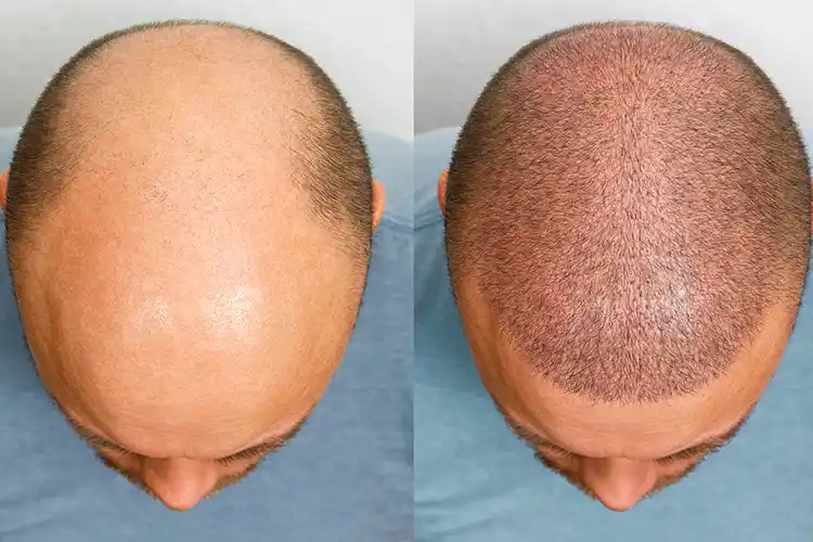 Uma imagem de antes e depois de um paciente após um transplante capilar