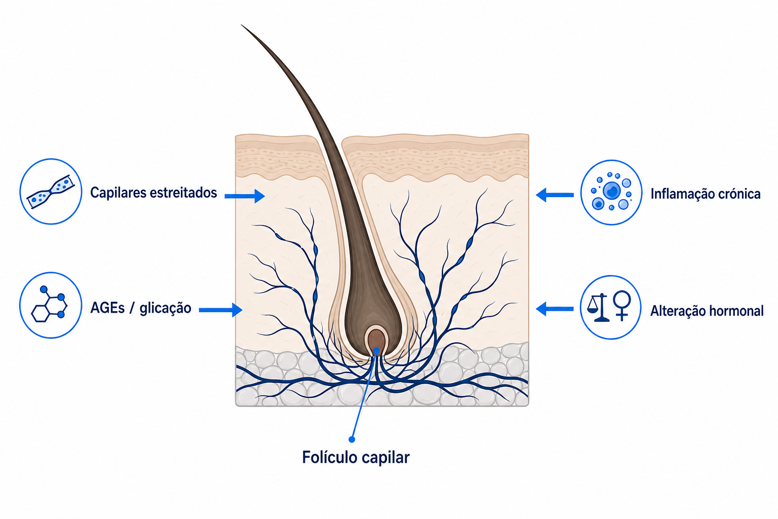 Ilustração de um folículo capilar em corte da pele com os quatro mecanismos pelos quais a diabetes perturba o crescimento do cabelo
