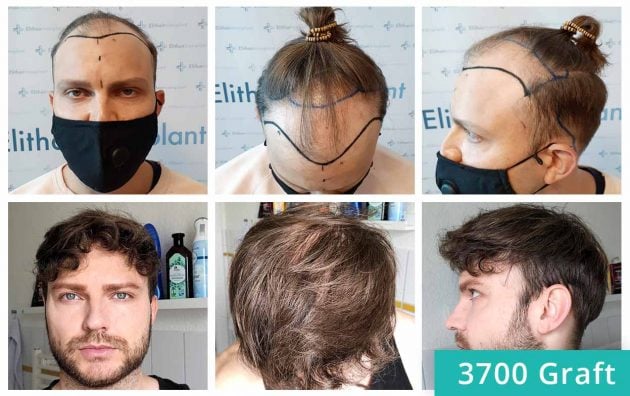 Before and after the hair transplant of Edgar Noskovs
