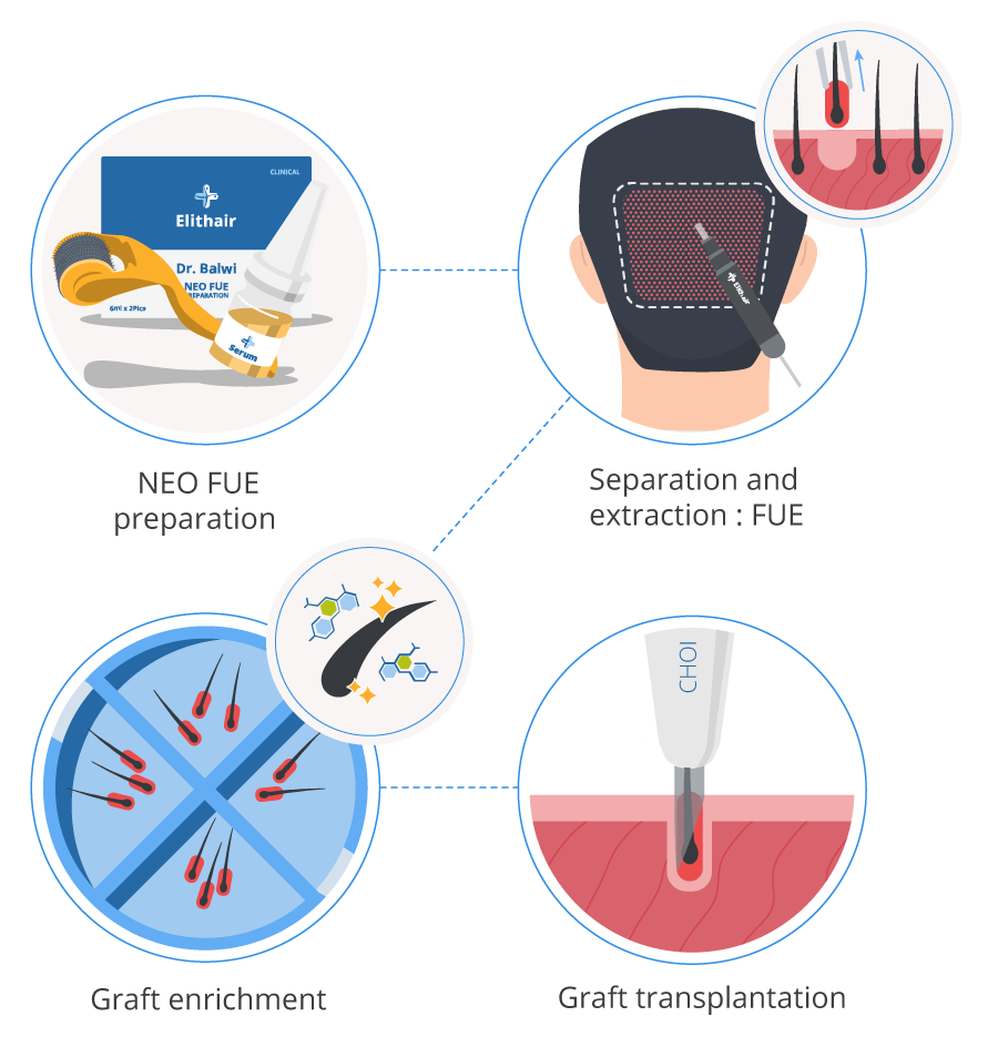 Infographic showing the steps of a hair transplant done with the Elithair clinic