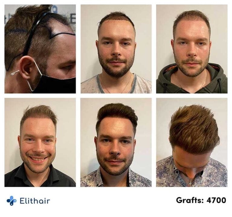 elithair-patient-before-and-after-dhi-hair-transplantation-4700-grafts-768x720