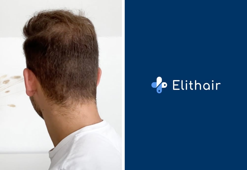Elithair Patient zeigt seinen Spenderbereich nach seiner Haartransplantation