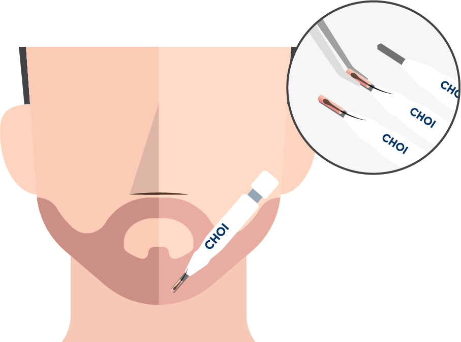 Grafik zeigt das Verpflanzen der Grafts im Gesicht bei der DHI Barttransplantation