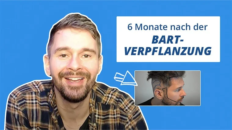 Thumbnail für das Barttransplantation Erfahrungen Video von Patient Ismar