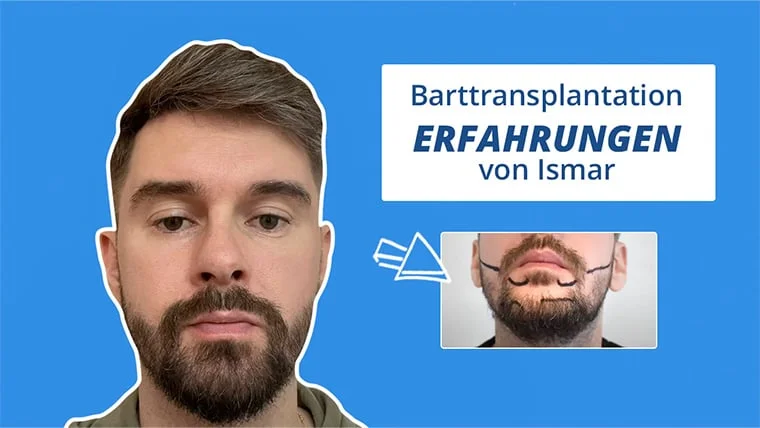 Thumbnail für das Barttransplantation Erfahrungen Video von Patient Ismar