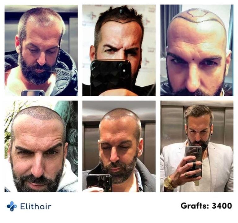 FUE saç ekimi öncesi ve sonrası fotoğrafları - Elithair - hasta Juergen - 3400 greft - 768x720