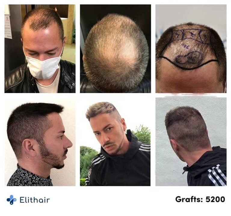 önce-ve-sonra-görüntüler-ilerleme-fue-dhi-saç-transplantasyonu-hasta-andre-5200-greft-768x720 (1)