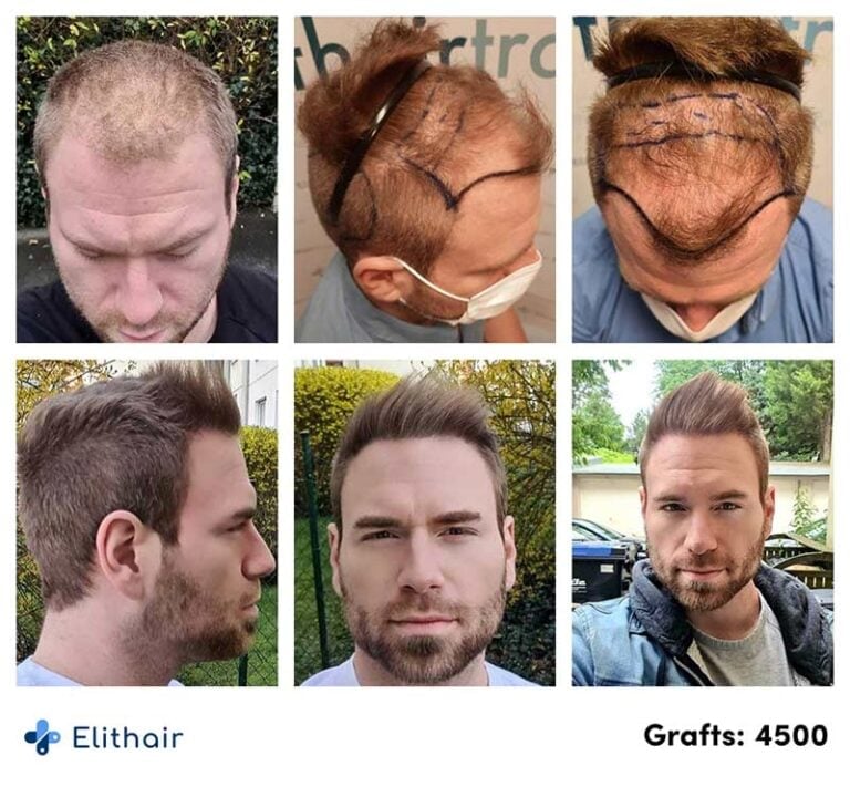 öncesi ve sonrası görüntüler-ilerleme-fue-saç-transplantasyonu-hasta-kewin-4500-greft-768x720
