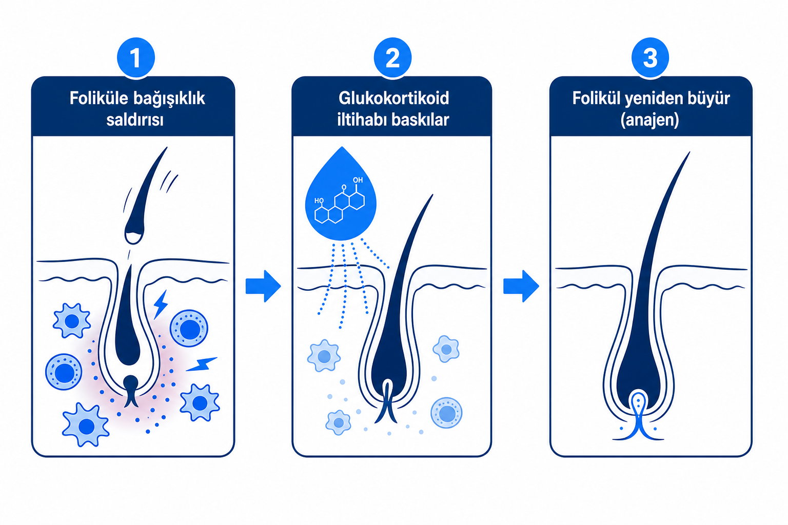 İnfografik: Glukokortikoidlerin saç folikülündeki bağışıklık saldırısını nasıl baskıladığı ve saçın yeniden uzamasını nasıl sağladığı