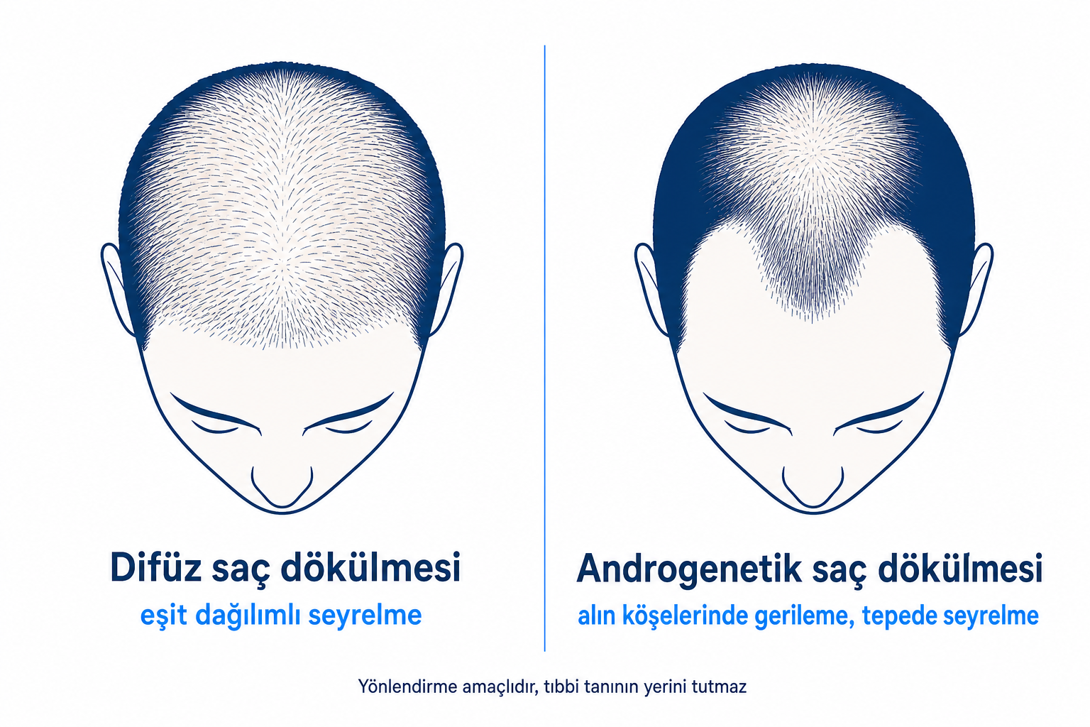 Difüz ve androgenetik saç dökülmesini karşılaştıran diyagram, seyrelme desenli iki baş silueti