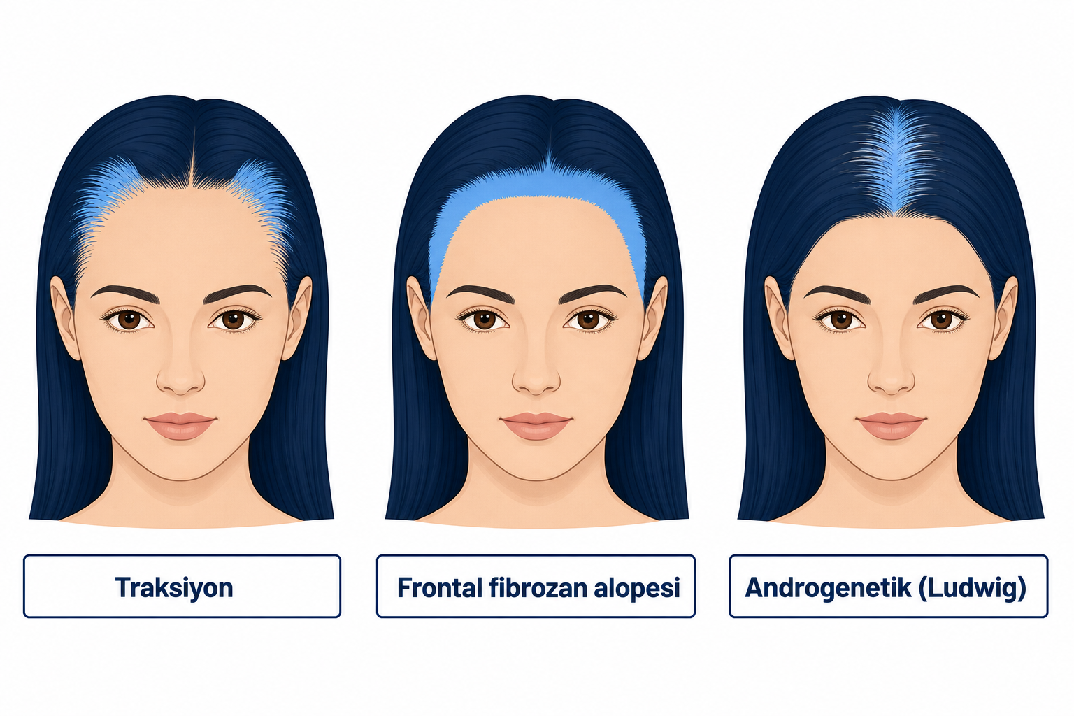Karşılaştırmalı üç kadın kafa diyagramı: traksiyon, frontal fibrozan alopesi ve androgenetik Ludwig örüntüsü