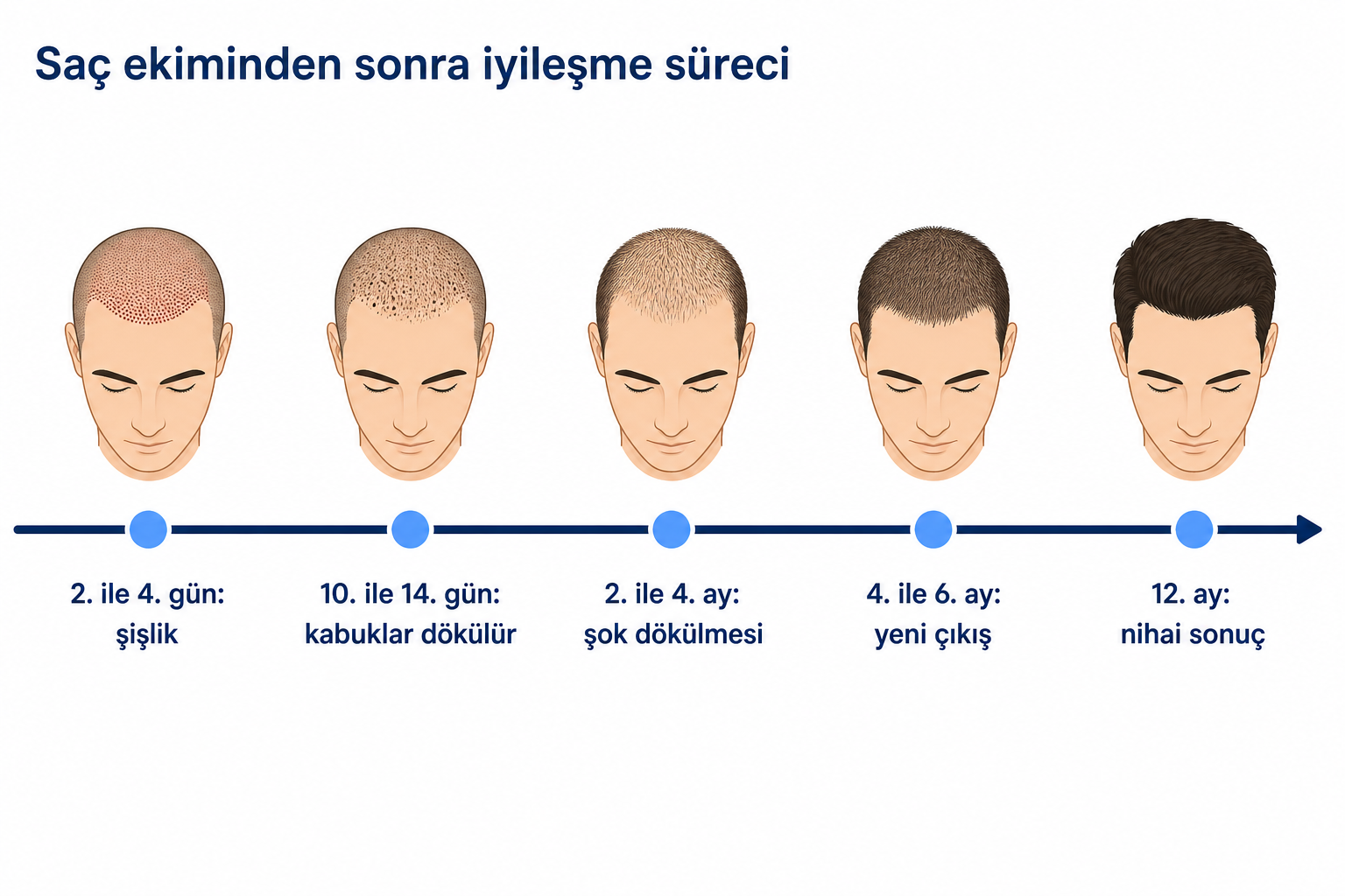Saç ekiminden sonra iyileşme sürecinin 2. günden 12. aya kadar zaman çizelgesi