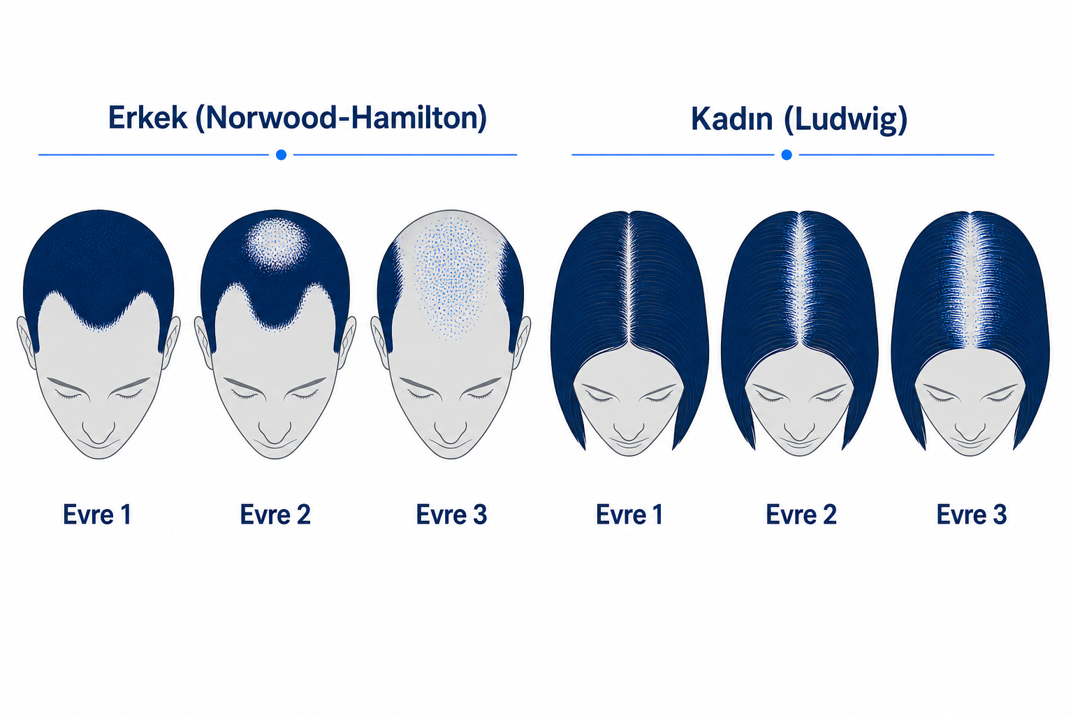 Erkekte (Norwood-Hamilton) ve kadında (Ludwig) androgenetik alopesiye bağlı saç dökülmesi desenlerinin şematik karşılaştırması