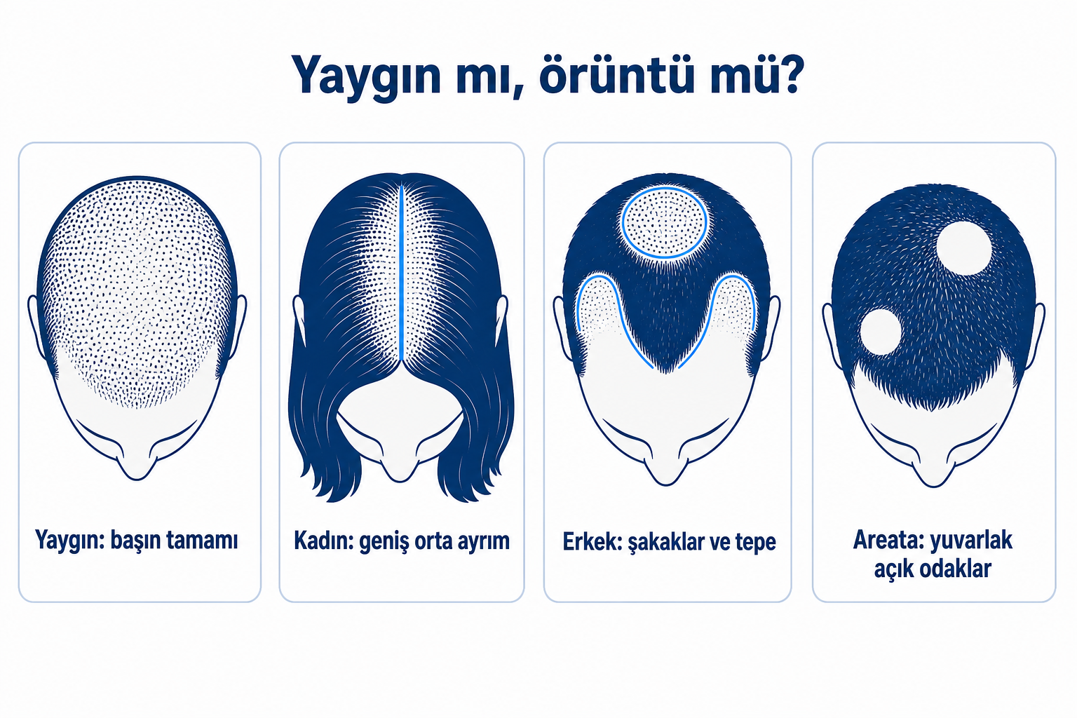 Dört saç dökülmesi örüntüsünün karşılaştırması: başın tamamında yaygın seyrelme, kadında genişlemiş orta ayrım, erkekte şakaklarda açılma ve seyrelen tepe, alopesi areatada yuvarlak saçsız odaklar