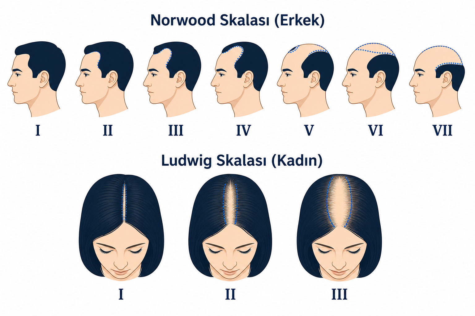 Desenli saç dökülmesini sınıflandırmak için erkeklerde Norwood skalası ve kadınlarda Ludwig skalası