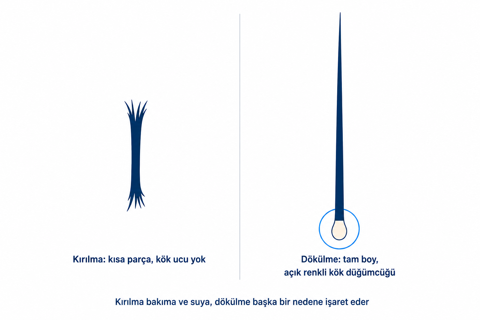 İllüstrasyon: kök kısmı olmayan kırık saç teli ile ucunda açık renkli kök düğümcüğü bulunan dökülmüş saç telinin karşılaştırması