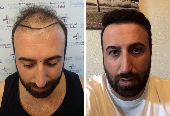 Top-of-head hair transplant before and after &ndash; Artin A., 3,500 grafts Sapphire FUE