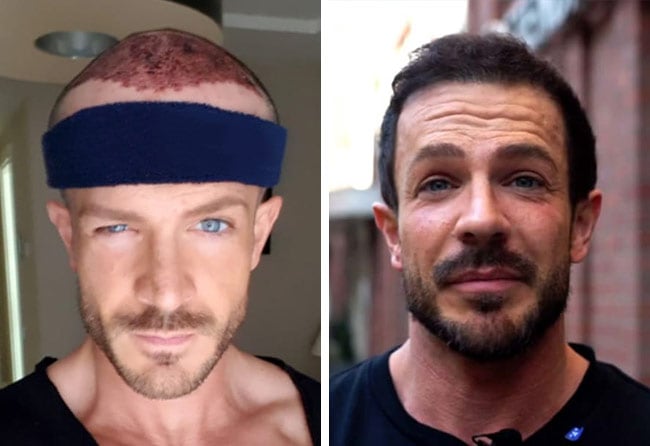 Simon Teichmann hair transplant at Elithair